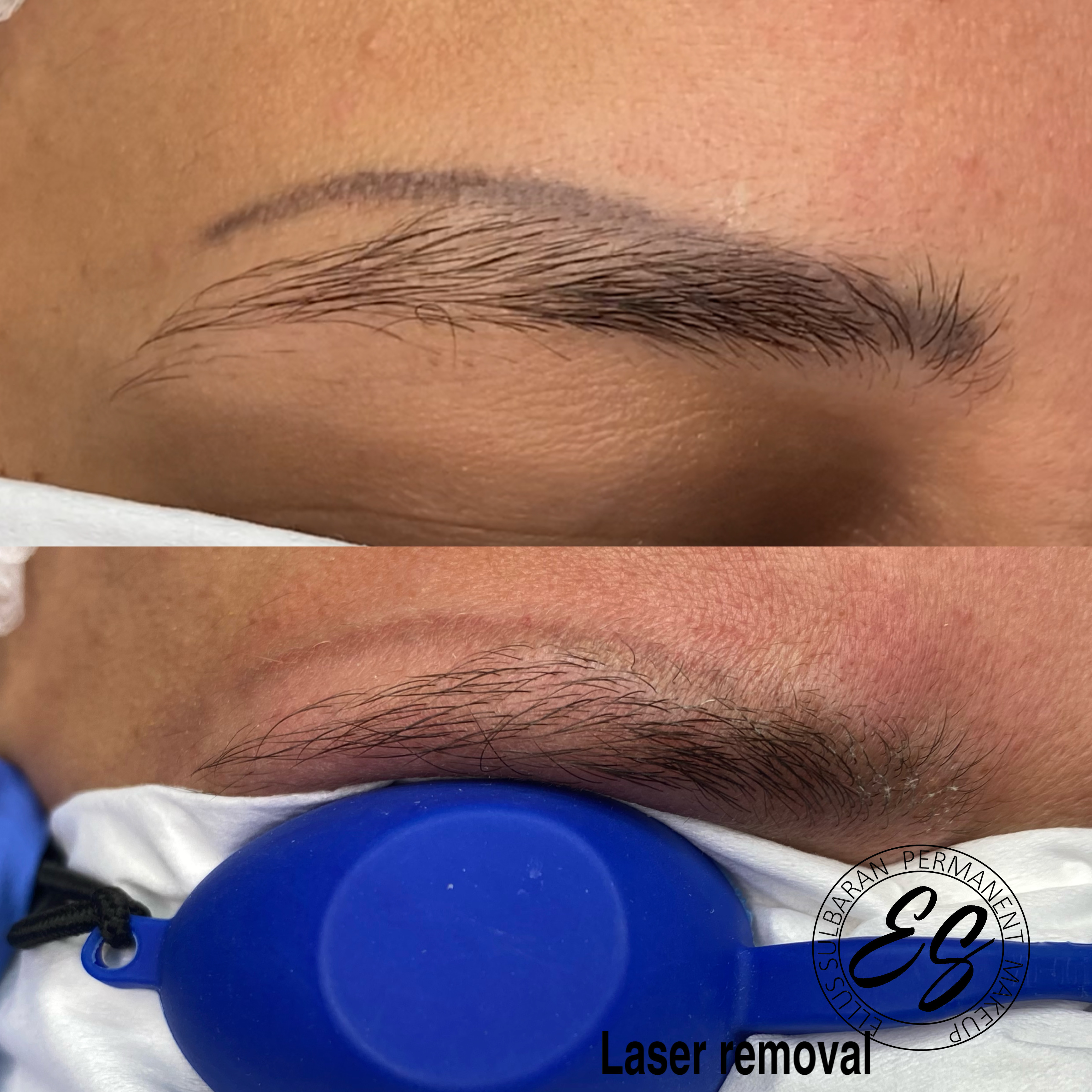 TATTO LASER REMOVAL/ REMOCION DE TATUAJES CON LASER