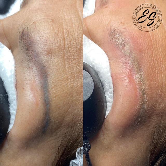 TATTO LASER REMOVAL/ REMOCION DE TATUAJES CON LASER