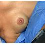 RECONSTRUCCION AREOLAR/ AREOLA TATTO