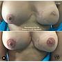 RECONSTRUCCION AREOLAR/ AREOLA TATTO